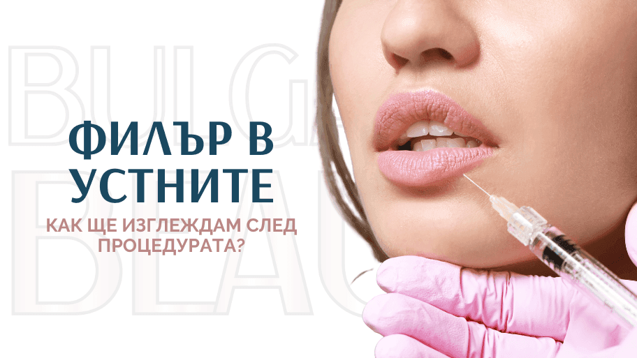 Процедура по поставяне на филтър в устните